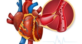 Penyempitan Pembuluh Darah Risiko Stroke